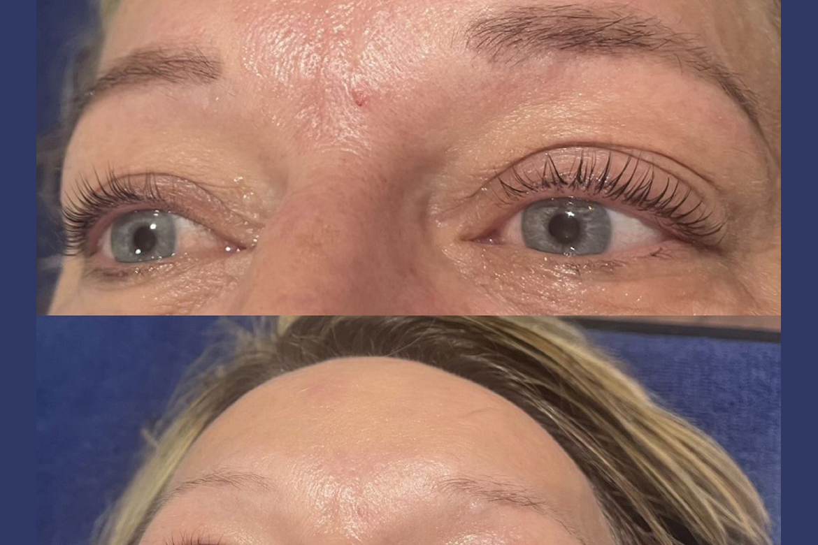 lash lifting